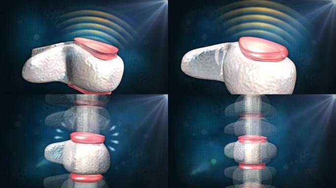 随着椎间盘恢复弹性椎骨间隙恢复正常椎间盘