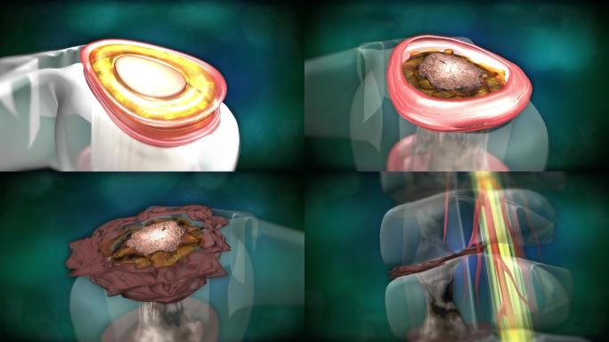 因髓液减少髓核干瘪椎间盘变形压迫血管神经