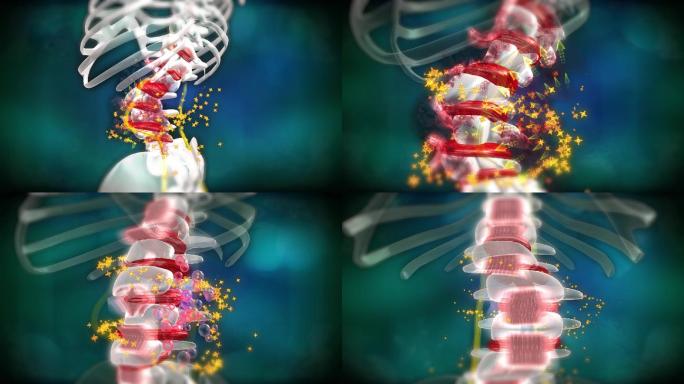 椎骨复位炎症解除，突出和骨刺不再生成