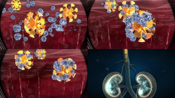 显微镜下清补素吸附肾腺毒素并血毒排除体外