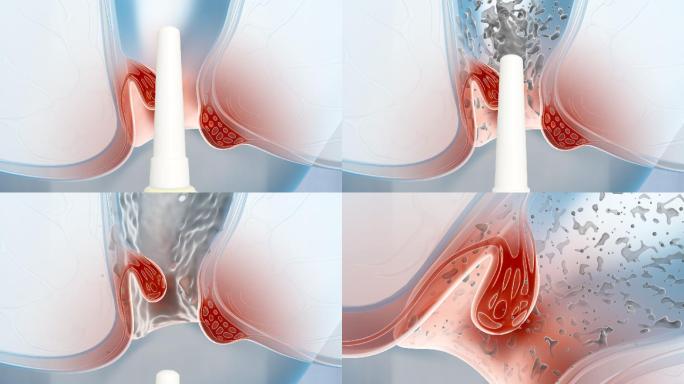 修复肛门粘膜受损切断痔核痔疮医药凝胶