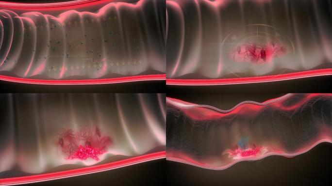 肠溶酶分泌减少造成粘膜发炎溃烂蠕动异常