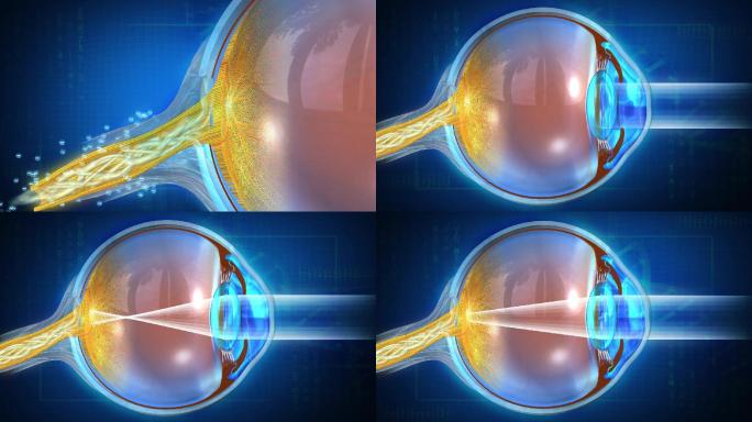 眼药保护视神经纠正近视远视屈光度杜绝复发