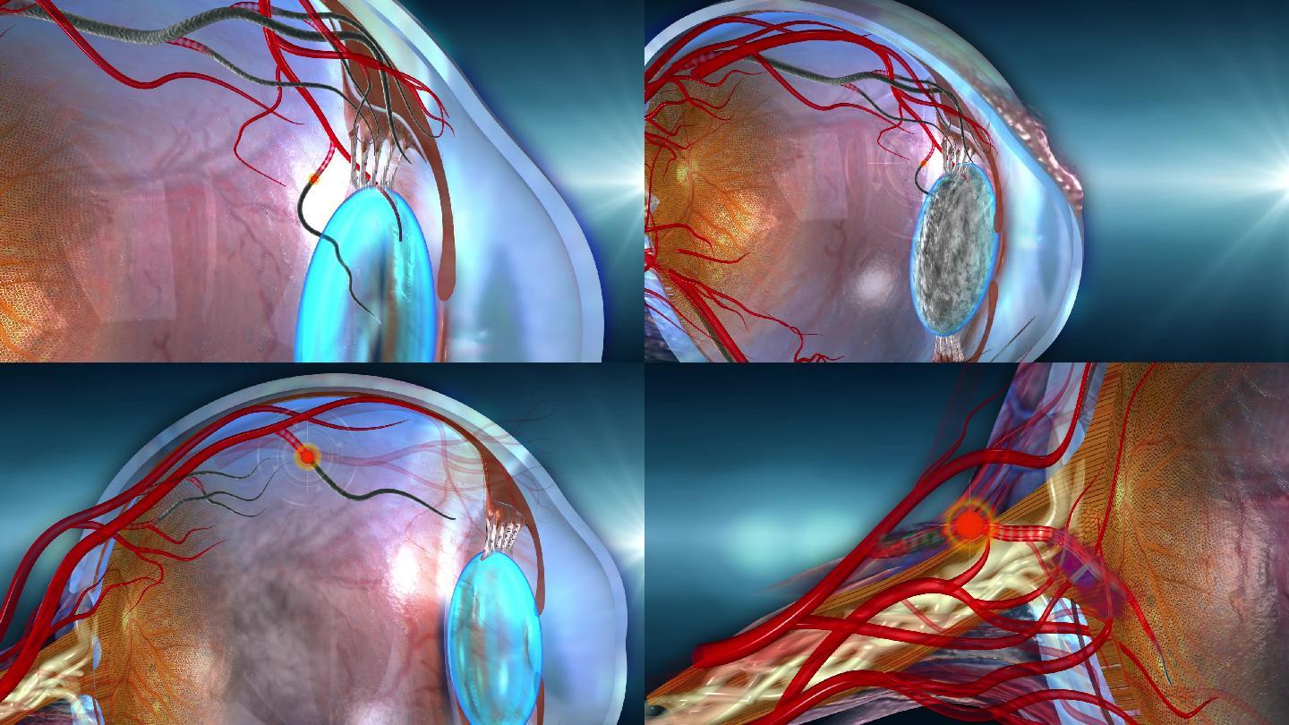 眼栓堵塞在眼睛前部中部后部引起多种眼病