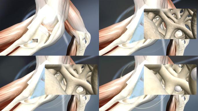增加骨密度医学三维动画骨关节骨病
