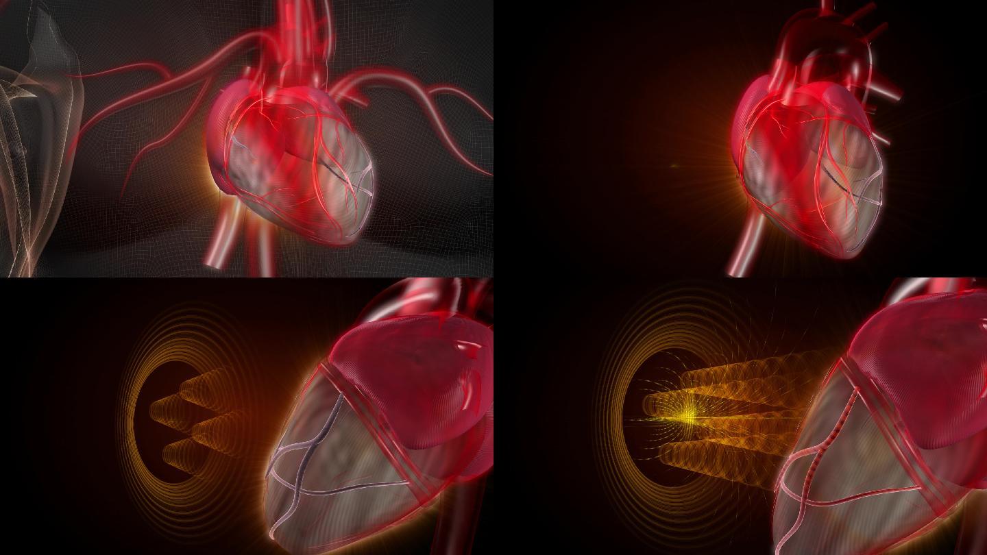 地石胸前对心脏冠状动脉释放远红外磁能量波