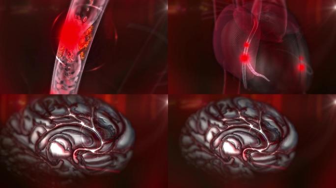 血液粘稠形成血栓堵在冠脉、脑血管、下肢