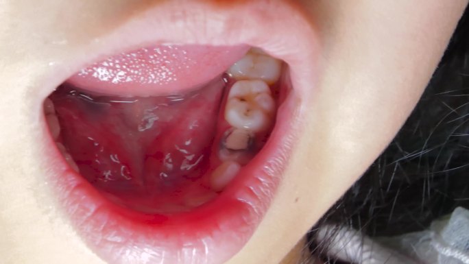 蛀牙虫牙坏牙