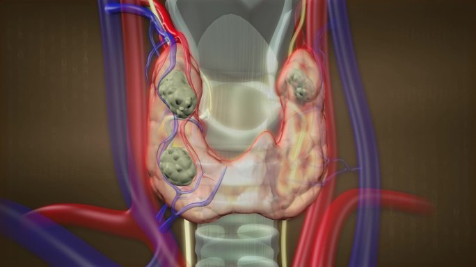 甲亢甲减甲状腺结节桥本氏甲状腺炎病变02