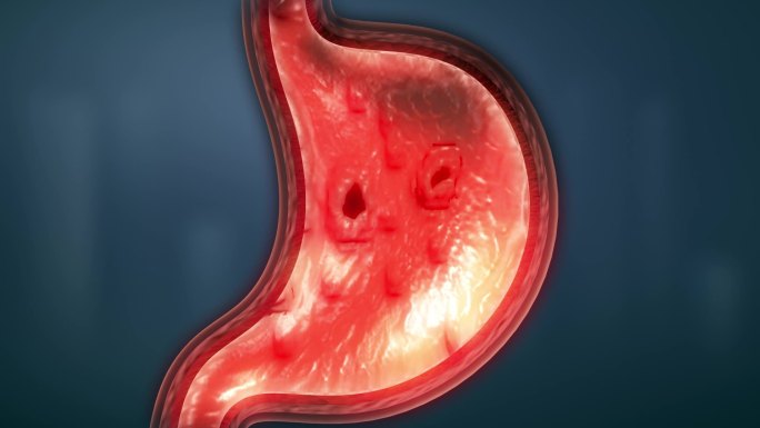 胃酸酒精幽门菌等导致胃黏膜三种程度损伤