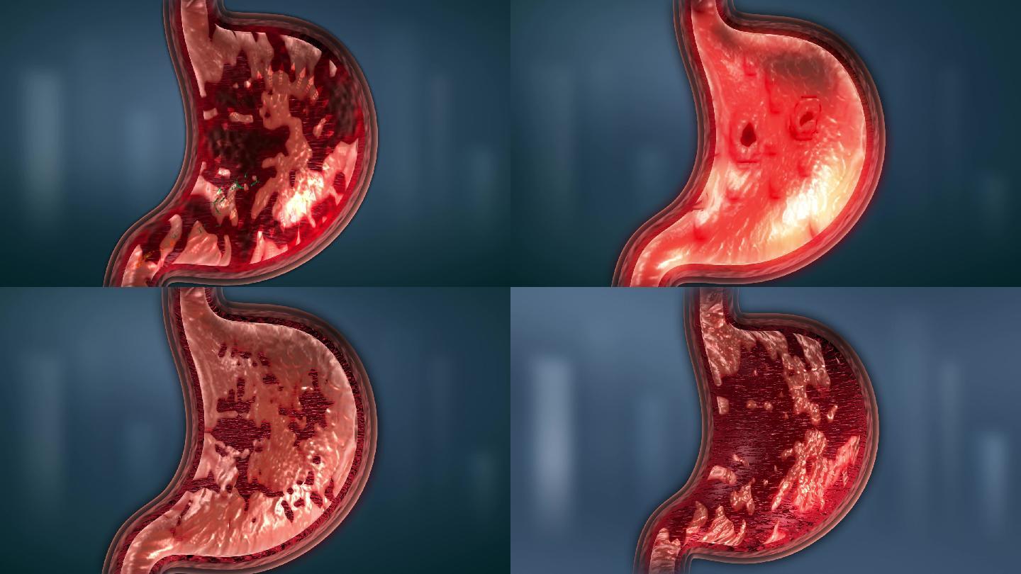 胃酸酒精幽门菌等导致胃黏膜三种程度损伤