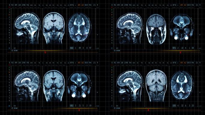 脑MRT扫描显示颞叶枕叶X射线图像
