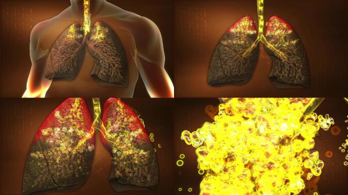 中医认为肺液是滋养肺泡、润滑气道的润滑液
