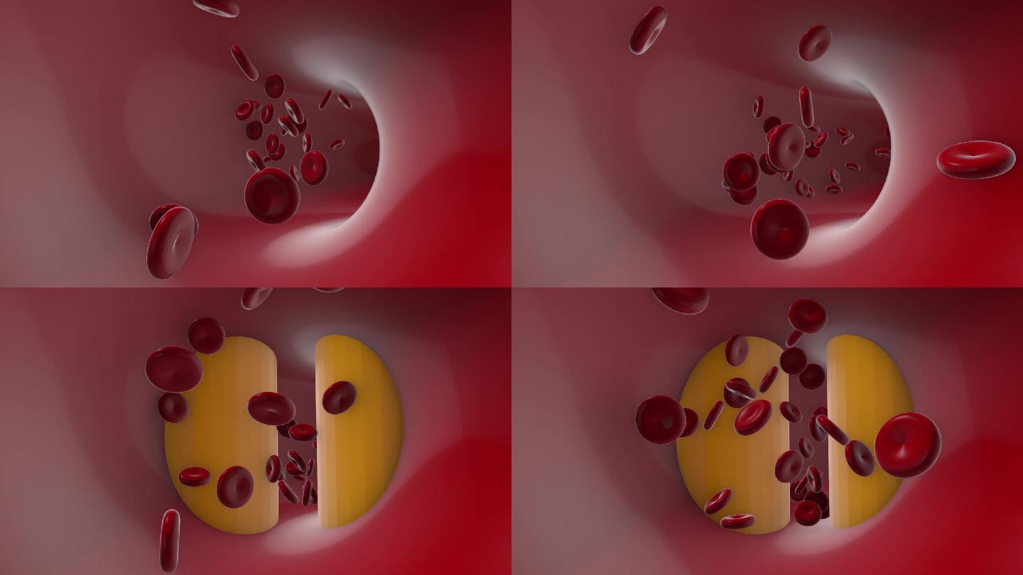 3D血管血栓堵塞动画