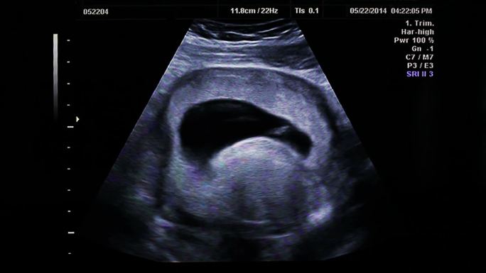 超声波胎儿B超孕育