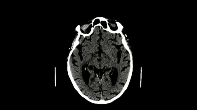 脑ct扫描医院医疗设备器械仪器脑部大脑头
