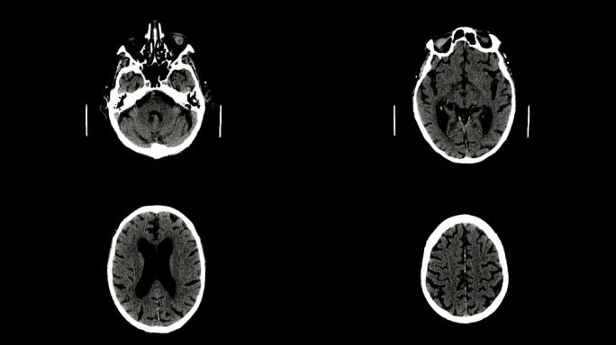 脑ct扫描医院医疗设备器械仪器脑部大脑头