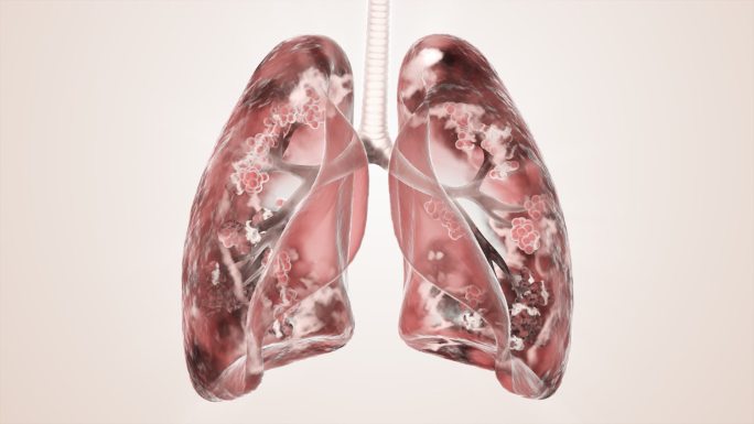 肺肺泡健康