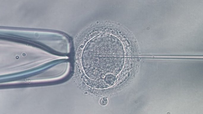 人卵穿刺和精子注射