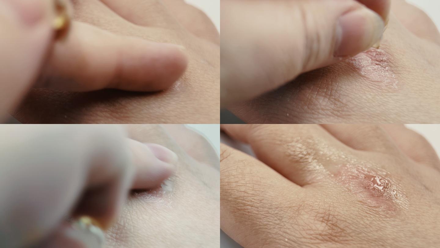 手手指4k皮肤皮炎破损炎症