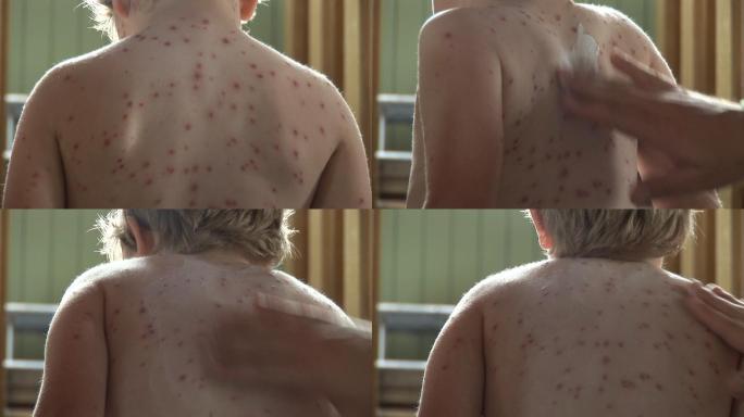 斑点和皮疹婴儿幼儿出疹子瘙痒痛苦折磨