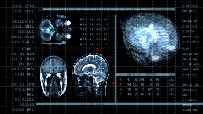 脑MRT扫描X光图像数据脑导水管