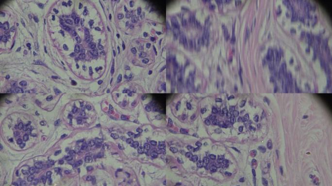 光镜下乳腺癌疾病医疗状况医学