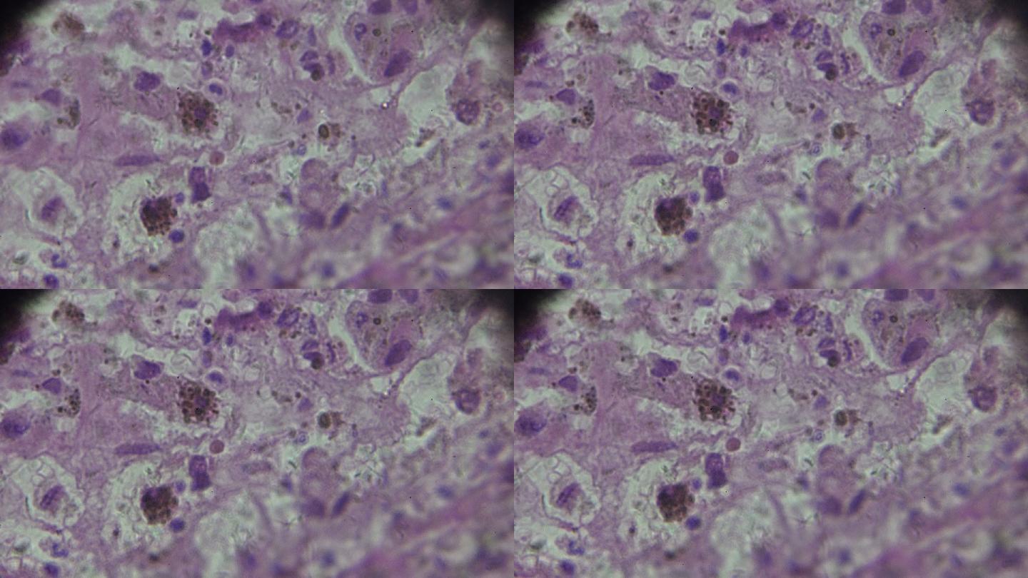 显微镜下的黑色素瘤活组织检查