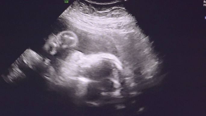 婴儿23周时的超声波检查