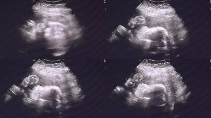 婴儿23周时的超声波检查