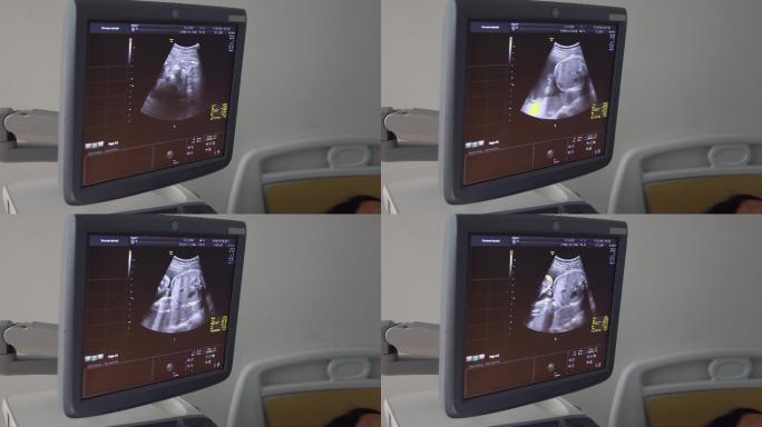 婴儿超声波检查