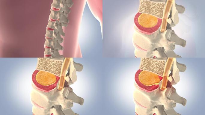 腰椎髓核突出压迫神经