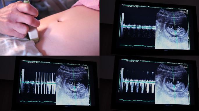 超声波孕妇肚子月子中心胎教母婴孕育怀孕十