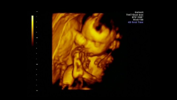 一个婴儿的超声波检查