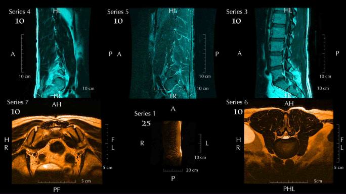 腰椎或脊柱下段磁共振图像