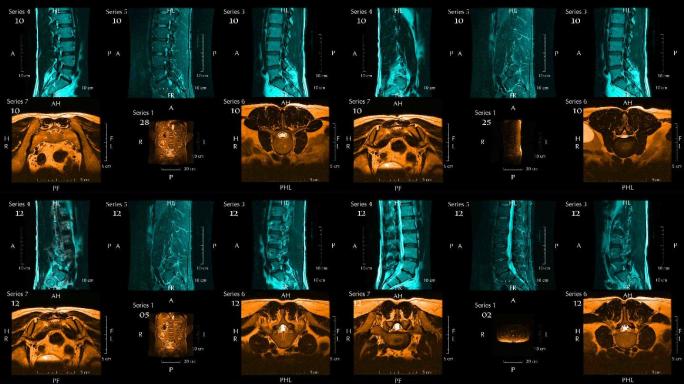 腰椎或脊柱下段磁共振图像
