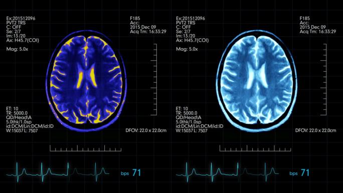 脑扫描脑部CT人脑扫描动态图大脑扫描图像