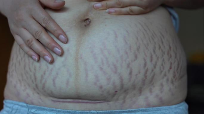 4K实拍产后妊娠纹，妊娠后皮肤真皮层断裂