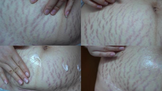 4K实拍产后妊娠纹，妊娠后皮肤真皮层断裂
