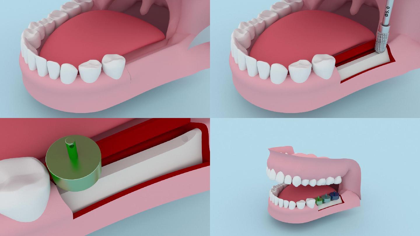 种植牙三维动画演示
