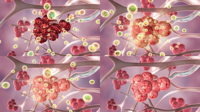 修复激活塌陷的肺泡恢复活力