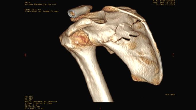 右肩CT显示肩胛骨骨折三维重建图像。