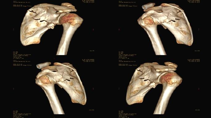 右肩CT显示肩胛骨骨折三维重建图像。