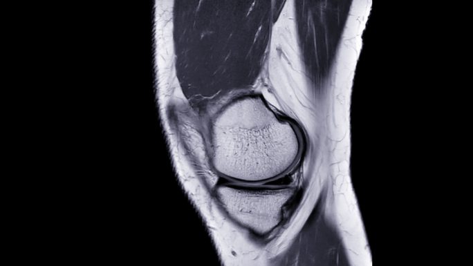 膝关节矢状位