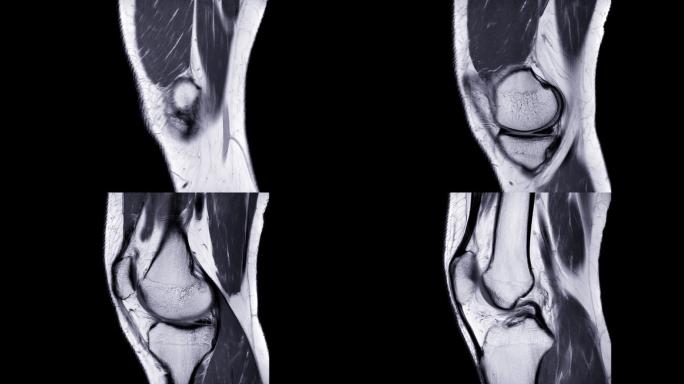 膝关节矢状位