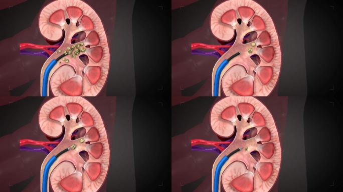 微创打碎肾结石取石