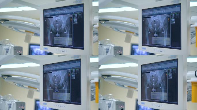 手术室屏幕上病人臀部的x光照片。