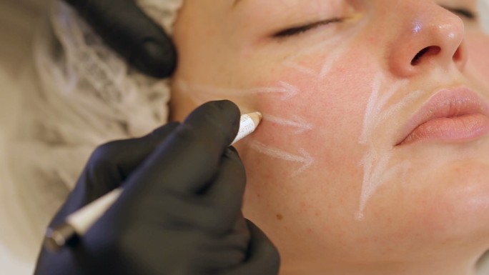 美容师用白铅笔在病人脸上画出轮廓