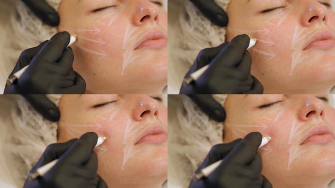 美容师用白铅笔在病人脸上画出轮廓
