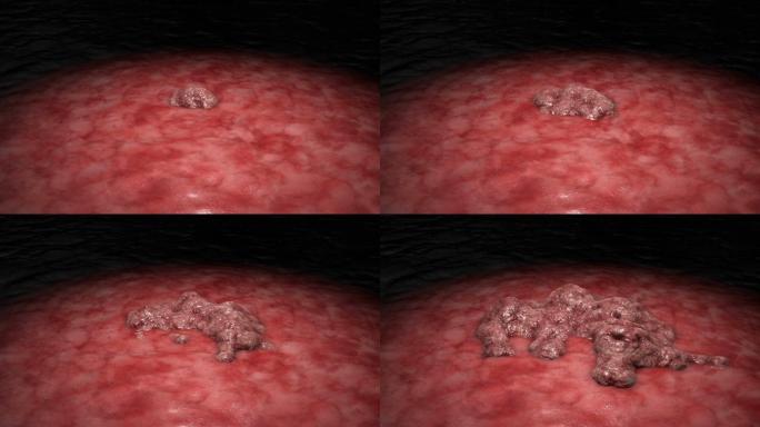 癌细胞生长动画病毒治疗内部进入胃癌肠癌